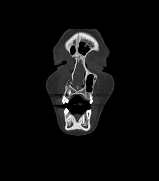 File:Nasoorbitoethmoid fracture (Radiopaedia 90044-107205 Coronal bone window 30).jpg
