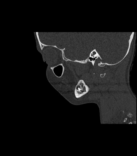 File:Nasoorbitoethmoid fracture (Radiopaedia 90044-107205 Sagittal bone window 43).jpg