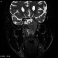 Nasopharyngeal carcinoma (Radiopaedia 4546-6667 Coronal T2 3).jpg