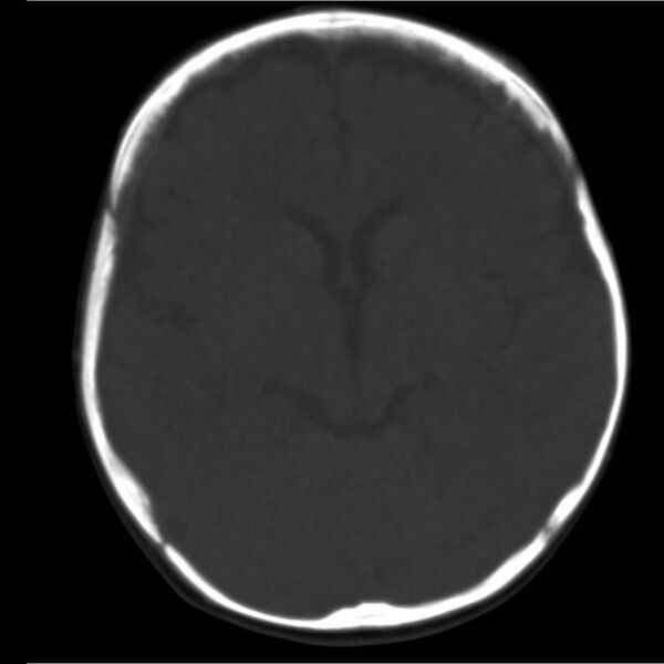 File:Neuroblastoma with skull metastases (Radiopaedia 30326-30958 Axial bone window 9).jpg