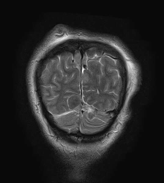 File:Neurofibromatosis type 2 (Radiopaedia 66211-75401 Coronal T2 23).jpg