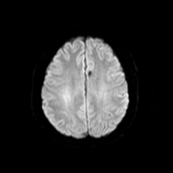 File:Neurofibromatosis type 2 (Radiopaedia 67470-76871 Axial DWI 14).jpg