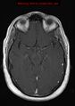 Neuroglial cyst (Radiopaedia 10713-11184 Axial T1 C+ 14).jpg