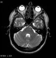 Neurosarcoidosis (Radiopaedia 10930-17204 Axial T2 5).jpg