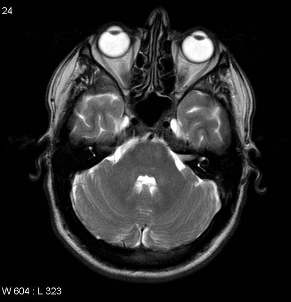 File:Neurosarcoidosis (Radiopaedia 10930-17204 Axial T2 5).jpg