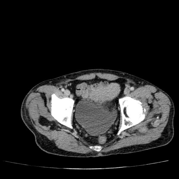 File:Non small-cell lung cancer (Radiopaedia 24467-24769 C+ delayed 111).jpg