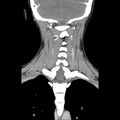 Normal CT of the neck (Radiopaedia 14575-14500 Coronal C+ 40).jpg