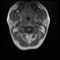 Normal cervical and thoracic spine MRI (Radiopaedia 35630-37156 Axial T1 28).png