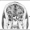 Normal coronal brain (Radiopaedia 6676-7910 B 9).jpg
