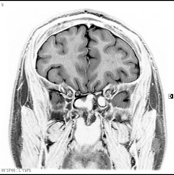 File:Normal coronal brain (Radiopaedia 6676-7910 B 9).jpg