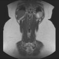 Normal liver MRI with Gadolinium (Radiopaedia 58913-66163 Coronal T2 36).jpg