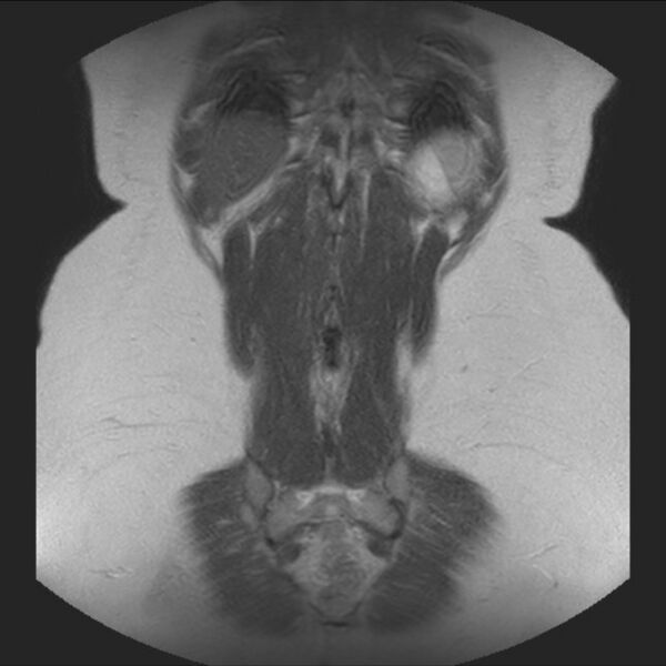 File:Normal liver MRI with Gadolinium (Radiopaedia 58913-66163 Coronal T2 36).jpg