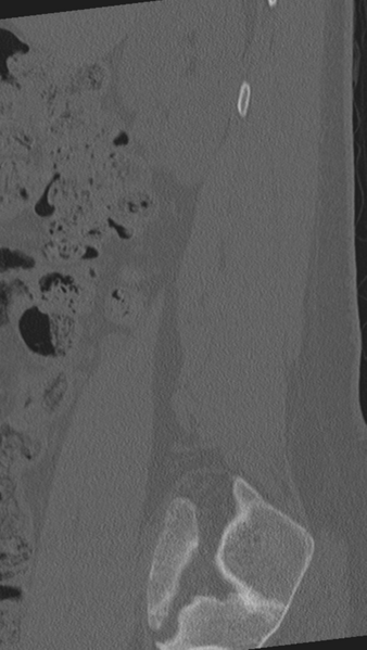 File:Normal lumbar spine CT (Radiopaedia 46533-50986 Sagittal bone window 88).png