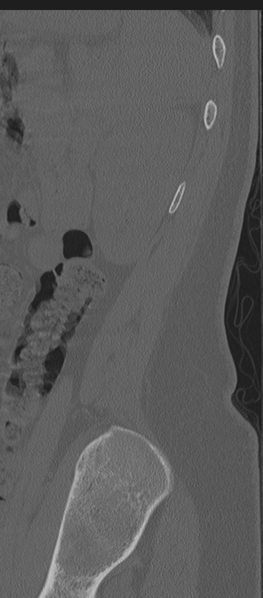File:Normal lumbosacral CT (Radiopaedia 37923-39867 Sagittal bone window 8).png