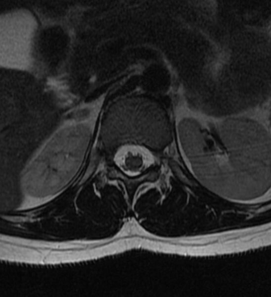 File:Normal thoracic spine MRI (Radiopaedia 41033-43781 Axial T2 30).jpg