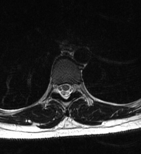 File:Normal thoracic spine MRI (Radiopaedia 41033-43781 Axial T2 7).jpg