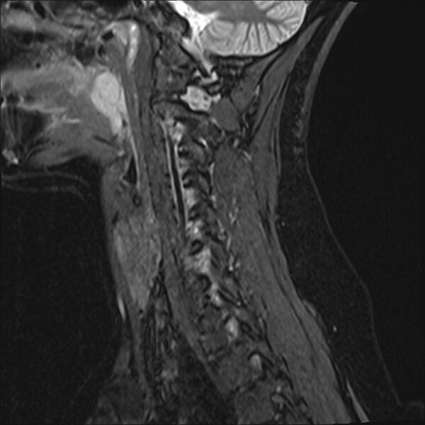 File:Normal trauma cervical spine MRI (Radiopaedia 32130-33071 Sagittal STIR 12).jpg