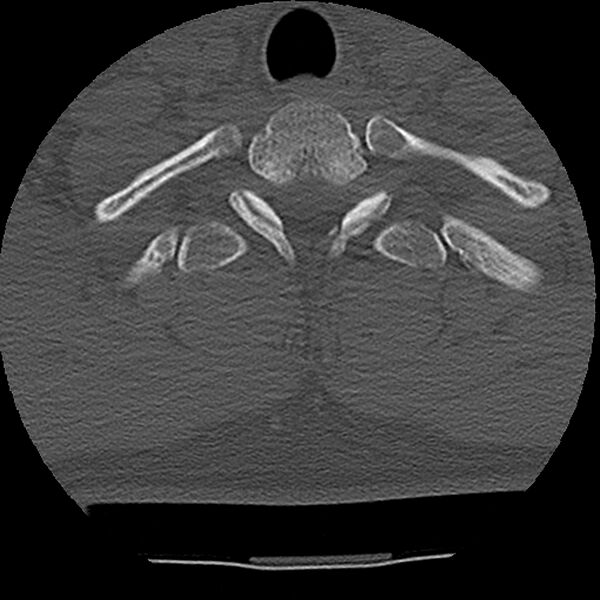 File:Normal trauma spine imaging (Radiopaedia 31753-32686 Axial bone window 77).jpg
