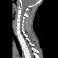 Normal trauma spine imaging (age 16) (Radiopaedia 45335-49358 C 16).jpg