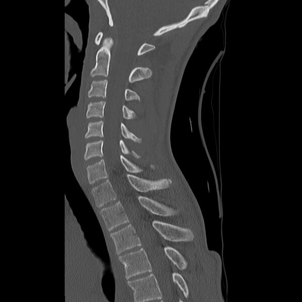 File:Normal trauma spine imaging (age 16) (Radiopaedia 45335-49358 Sagittal bone window 18).jpg