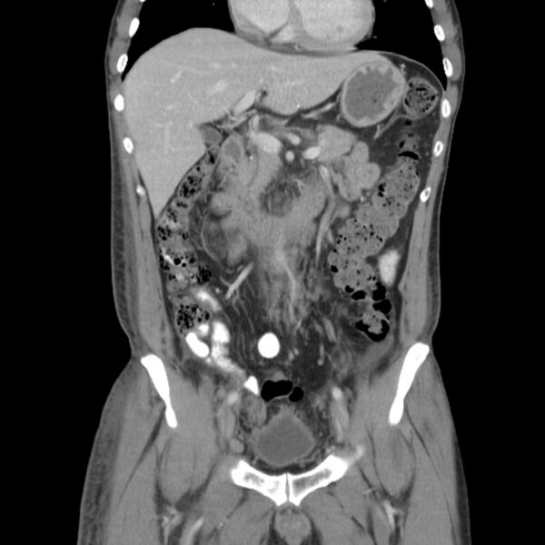 File:Obstructive bladder transitional cell carcinoma (Radiopaedia 9825-10410 B 7).jpg