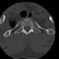 Occipital condyle fracture (Radiopaedia 31755-32691 Axial bone window 84).jpg