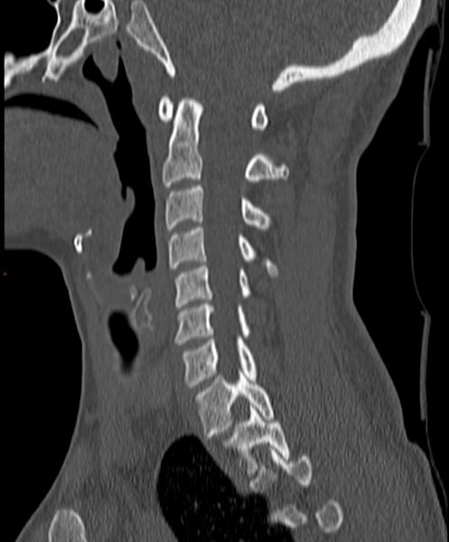 File:Occipital condyle fracture (Radiopaedia 61165-69056 Sagittal bone window 12).jpg