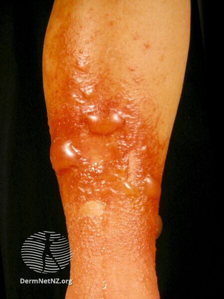 File:Topical medication allergy (DermNet NZ dermatitis-topical-medicine-allergy2).jpg