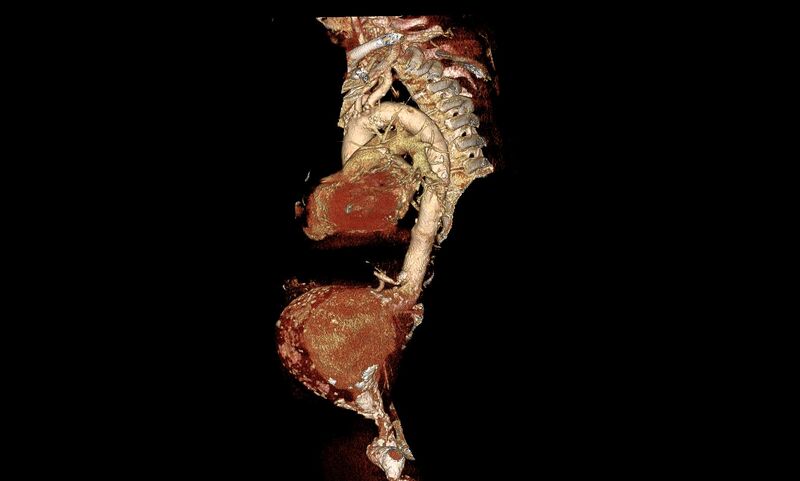 File:Abdominal aortic aneurysm- extremely large, ruptured (Radiopaedia 19882-19921 3D 8).jpg