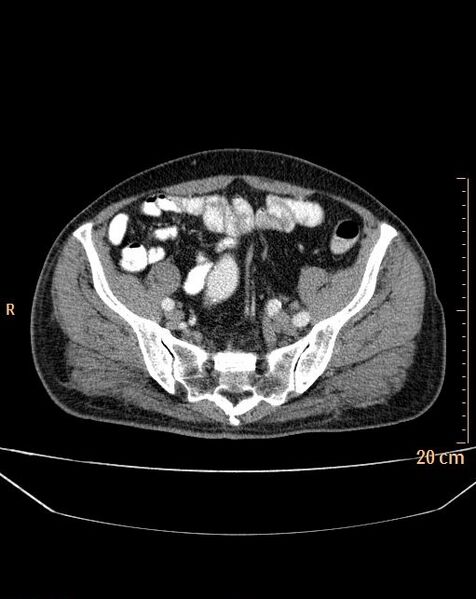File:Abdominal aortic aneurysm (Radiopaedia 25985-26121 Axial C+ arterial phase 35).jpg