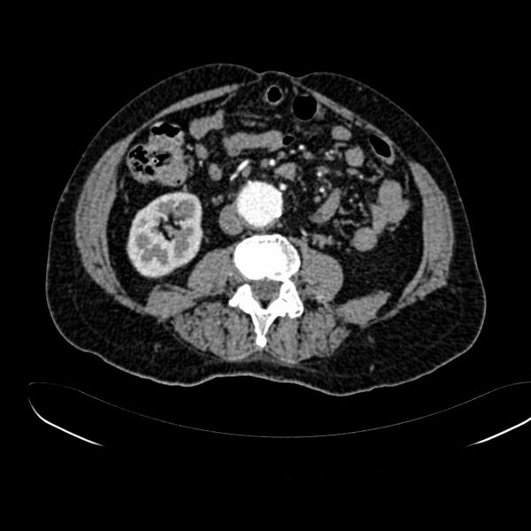 File:Abdominal aortic aneurysm (Radiopaedia 75131-86203 Axial C+ arterial phase 26).jpg