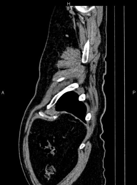 File:Abdominal aortic aneurysm (Radiopaedia 83094-97462 Sagittal renal cortical phase 116).jpg