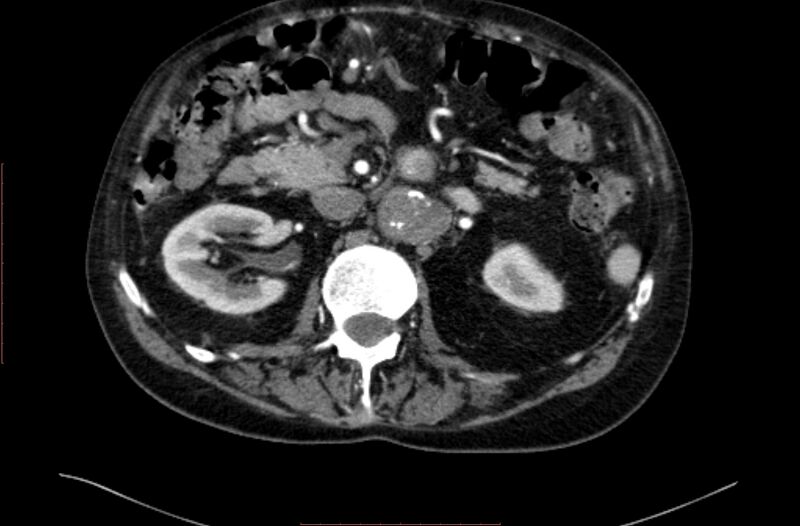 File:Abdominal aortic interposition tube graft and aneurysm thrombosis (Radiopaedia 71438-81857 Axial C+ arterial phase 48).jpg