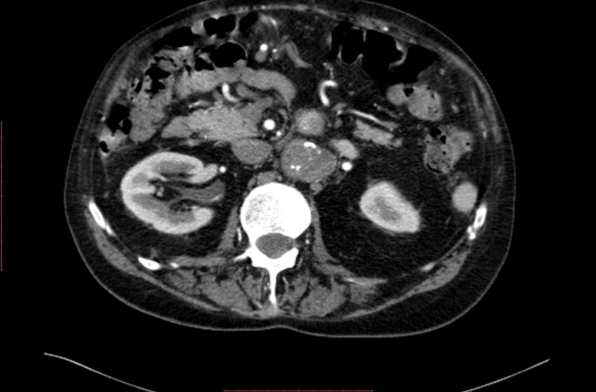Abdominal aortic interposition tube graft and aneurysm thrombosis (Radiopaedia 71438-81857 Axial C+ arterial phase 48).jpg