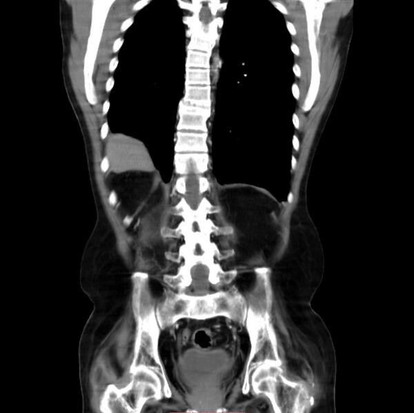 File:Abdominal aortic interposition tube graft and aneurysm thrombosis (Radiopaedia 71438-81857 Coronal C+ arterial phase 21).jpg