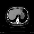 Abdominal wall endometriosis (Radiopaedia 25723-25885 Axial C+ portal venous phase 5).jpg