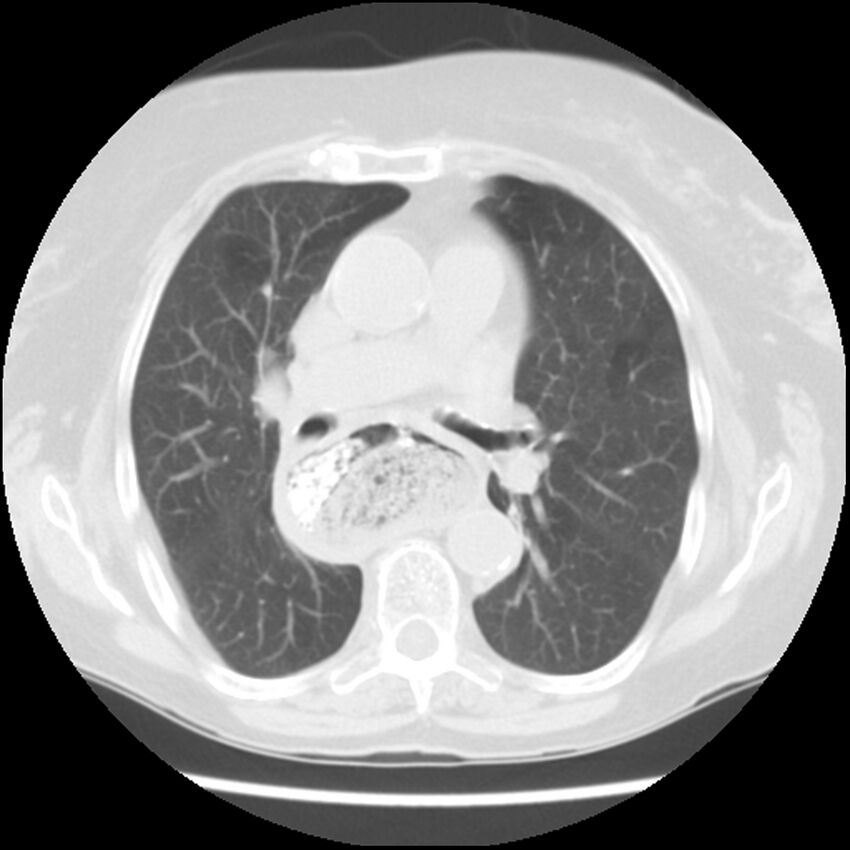 Achalasia (Radiopaedia 44094-47649 Axial lung window 27).jpg