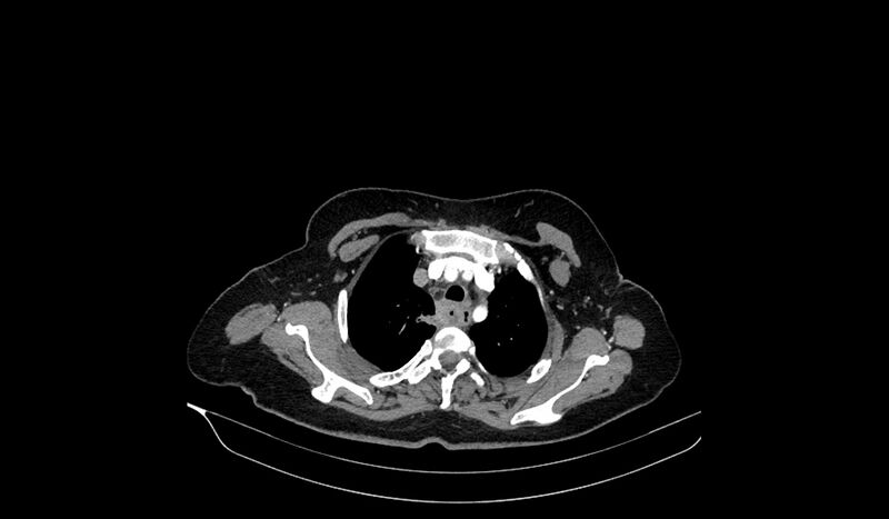 File:Acquired tracheo-esophageal fistula (Radiopaedia 51356-57103 Axial C+ arterial phase 25).jpg