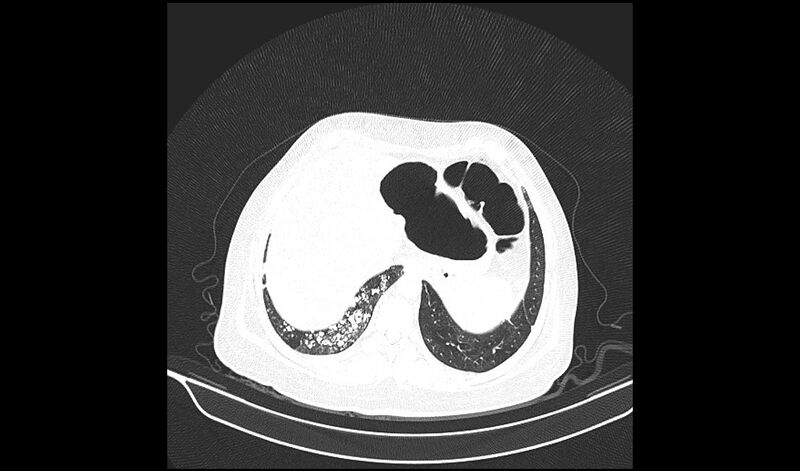 File:Acquired tracheo-esophageal fistula (Radiopaedia 51356-57103 Axial lung window 37).jpg