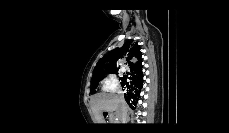 File:Acquired tracheo-esophageal fistula (Radiopaedia 51356-57103 Sagittal C+ arterial phase 10).jpg