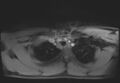 Active right ventricular cardiac sarcoidosis (Radiopaedia 55596-62100 Axial Post contrast Dixon 3).jpg