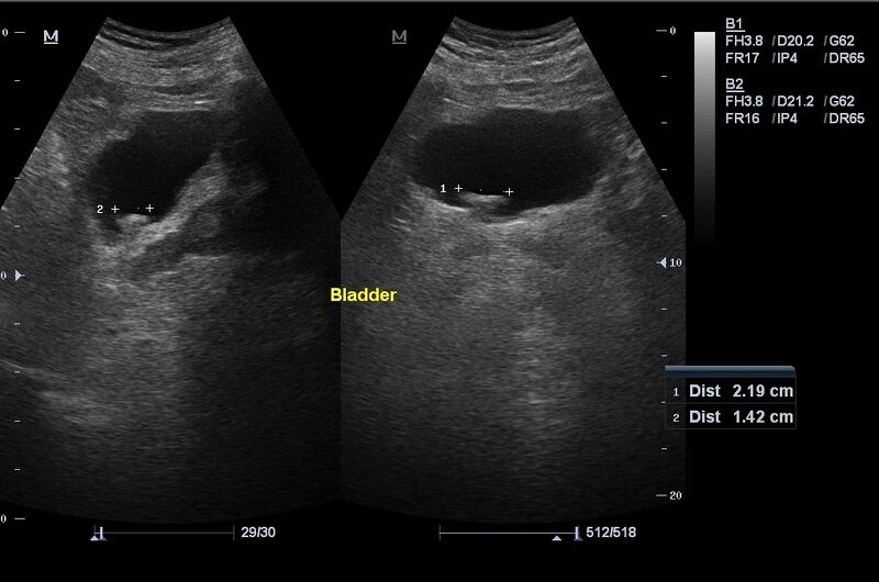 File:Acute calculous cholecystitis and bladder tumor (Radiopaedia 17032-16733 Left image longitudinal and the right is transverse 1).jpg