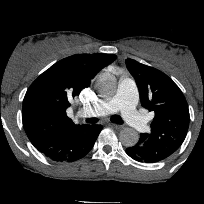 Acute chest syndrome - sickle cell disease (Radiopaedia 42375-45499 Axial C+ CTPA 76).jpg