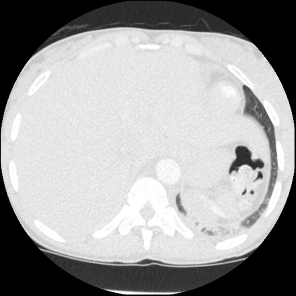 File:Acute chest syndrome - sickle cell disease (Radiopaedia 42375-45499 Axial lung window 169).jpg
