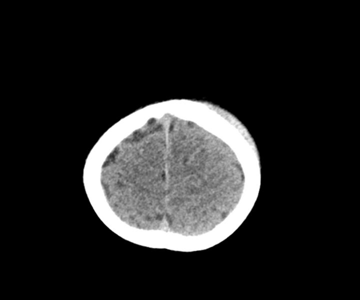 File:Acute epidural hematoma (Radiopaedia 63659-72335 Axial non-contrast 24).jpg