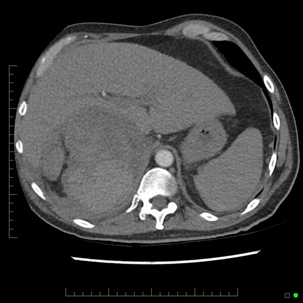File:Acute hemorrhage into adrenal metastasis from NSCLC (Radiopaedia 43135-46429 Axial C+ CTPA 10).jpg