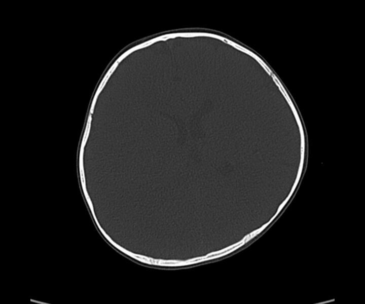 File:Acute hemorrhagic contusion (Radiopaedia 63660-72336 Axial bone window 40).jpg