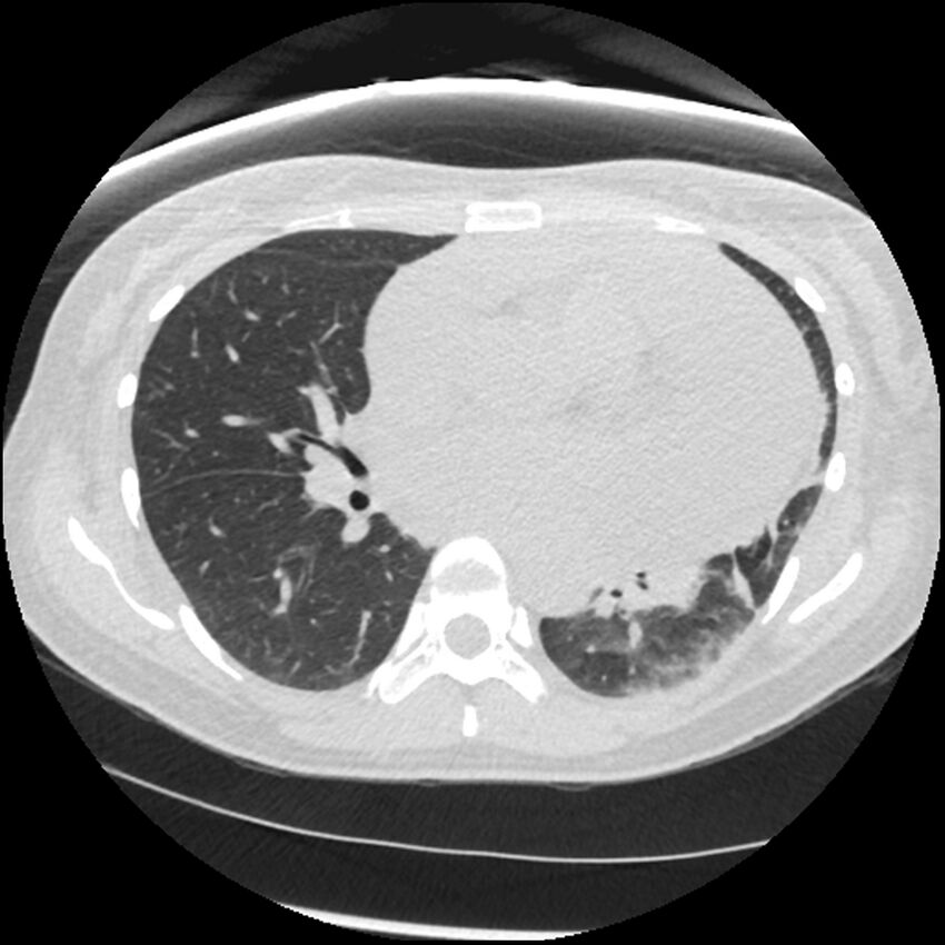 Acute lupus nephritis (Radiopaedia 45832-50107 Axial lung window 48).jpg