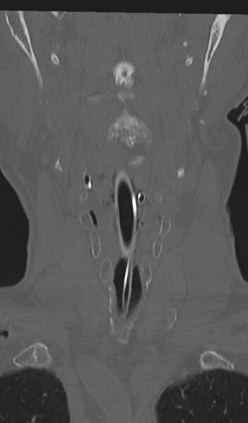 File:Acute on chronic subdural hematoma and thoracic vertebral injury in a multitrauma patient (Radiopaedia 31698-32619 Coronal bone window 7).jpg