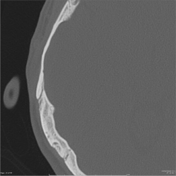 File:Acute otomastoiditis (Radiopaedia 28276-28512 Axial PTB bone window reformat 5).jpg